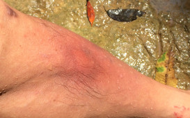 傷口から感染して腫れた脛