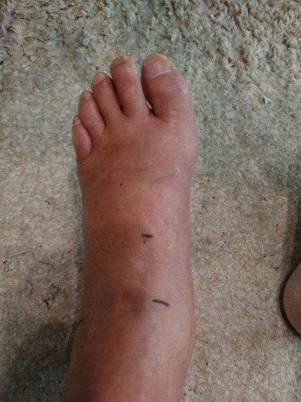 ゾウの足のように腫れあがってしまった左足、黒いマークは測定の目印